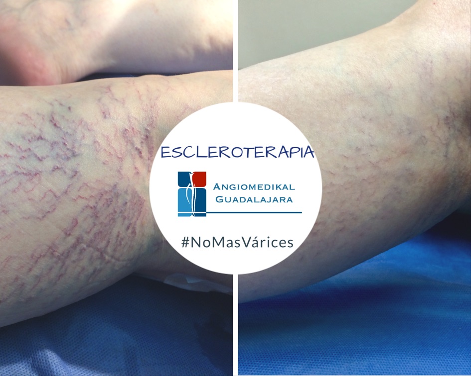 Manejo de la insuficiencia venosa Grado 1 con escleroterapia