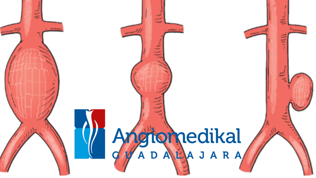 Aneurisma de Aorta Abdominal – Angiología, Cirugía Vascular y Endovascular